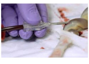 Benefits umbilical cord blood banking