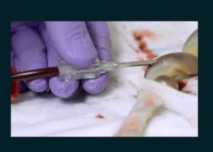 umbilical cord blood banking